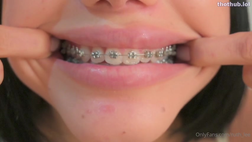 OnlyFans leaked Ruth Lee braces on HDthot